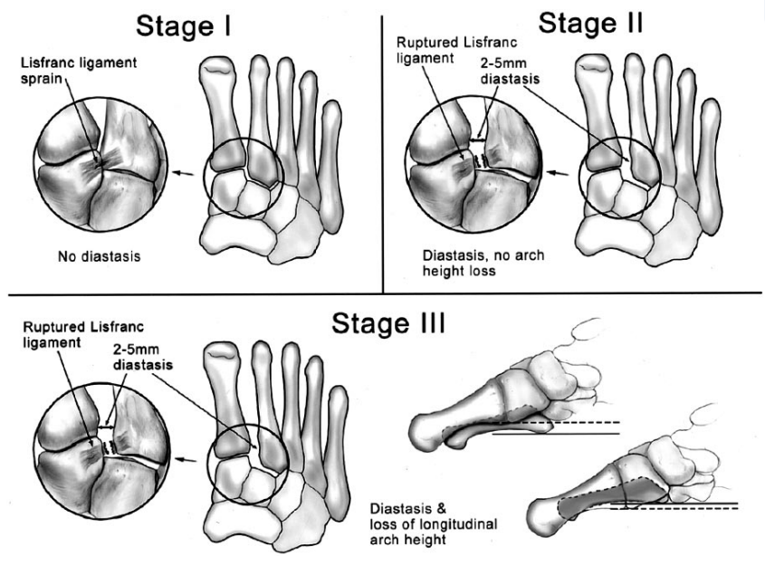 影像PPT - 为什么 Lisfranc 关节损伤处理那么重要-7 影像PPT - 为什么 Lisfranc 关节损伤处理那么重要-7