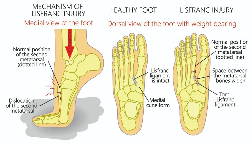 影像PPT - 为什么 Lisfranc 关节损伤处理那么重要-2 影像PPT - 为什么 Lisfranc 关节损伤处理那么重要-2