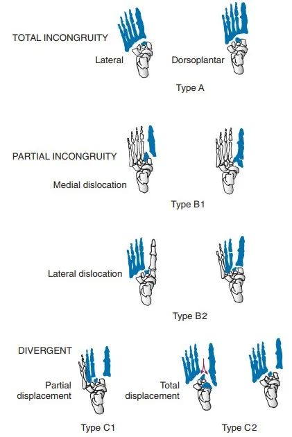影像PPT - 为什么 Lisfranc 关节损伤处理那么重要-6 影像PPT - 为什么 Lisfranc 关节损伤处理那么重要-6