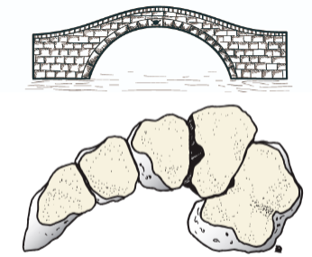 影像PPT - 为什么 Lisfranc 关节损伤处理那么重要-4 影像PPT - 为什么 Lisfranc 关节损伤处理那么重要-4