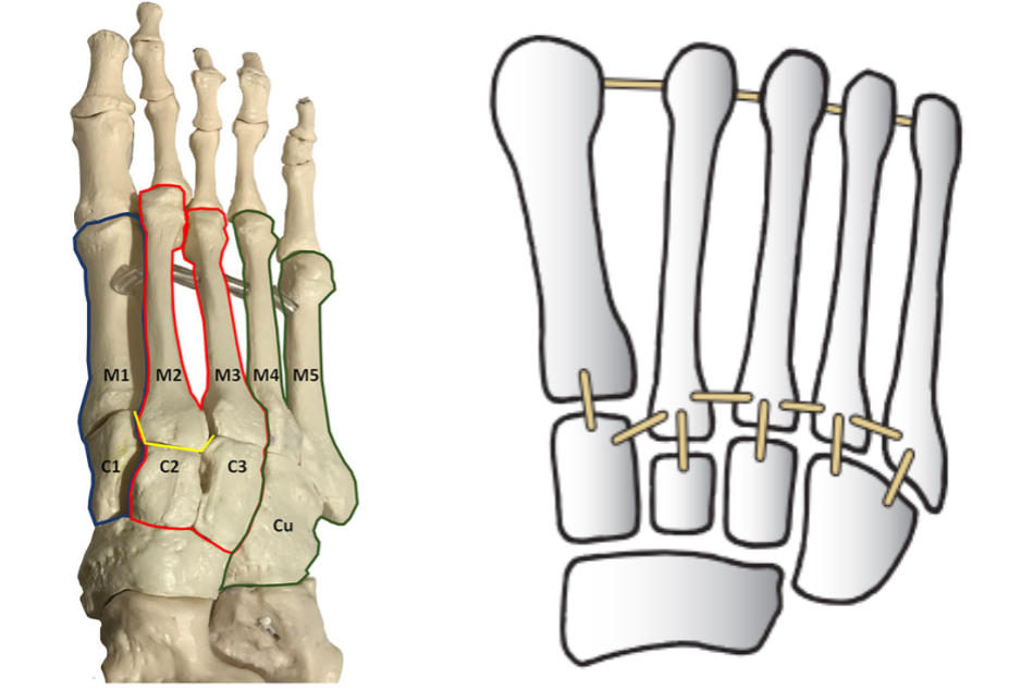 影像PPT - 为什么 Lisfranc 关节损伤处理那么重要-3 影像PPT - 为什么 Lisfranc 关节损伤处理那么重要-3