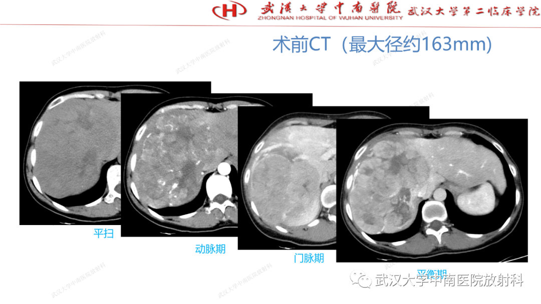 影像PPT - 【PPT】“不可切除”肝癌的TACE转化治疗-16