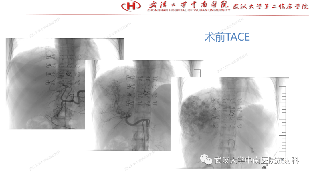 影像PPT - 【PPT】“不可切除”肝癌的TACE转化治疗-22