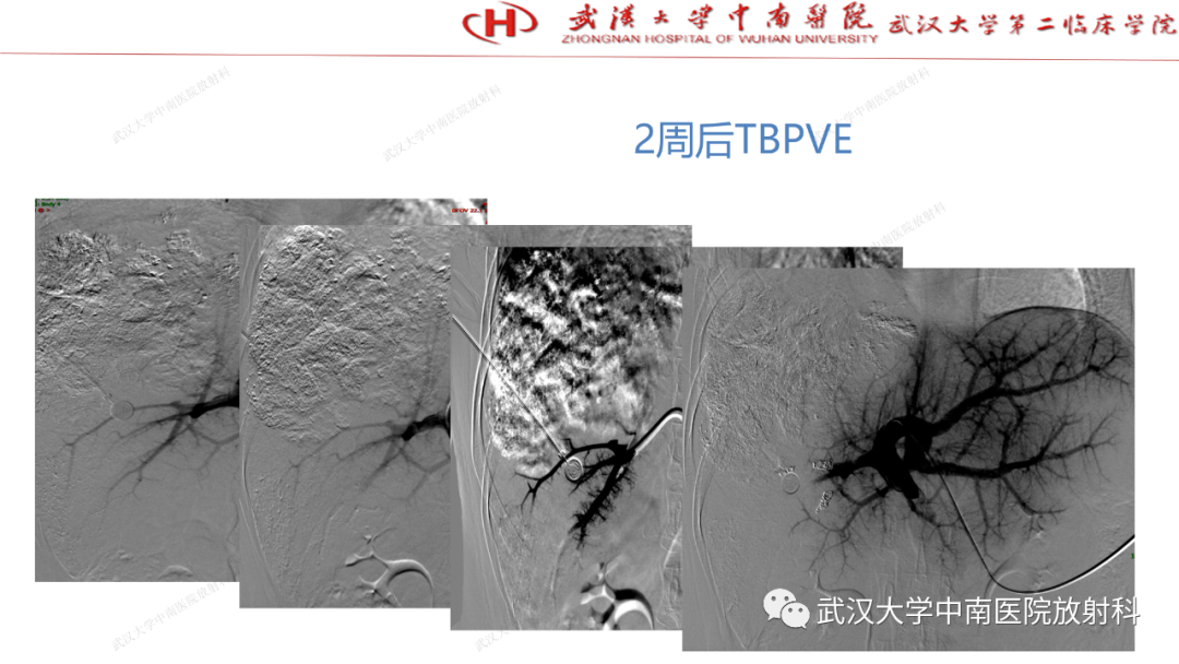 影像PPT - 【PPT】“不可切除”肝癌的TACE转化治疗-23