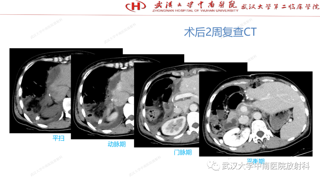 影像PPT - 【PPT】“不可切除”肝癌的TACE转化治疗-26
