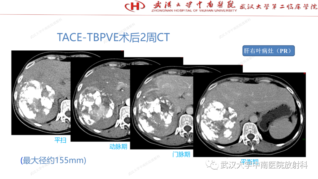 影像PPT - 【PPT】“不可切除”肝癌的TACE转化治疗-24