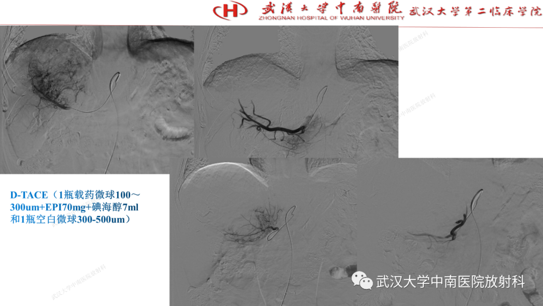 影像PPT - 【PPT】“不可切除”肝癌的TACE转化治疗-36