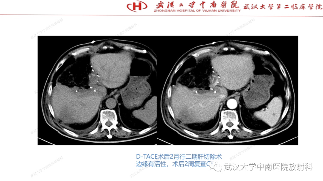 影像PPT - 【PPT】“不可切除”肝癌的TACE转化治疗-39