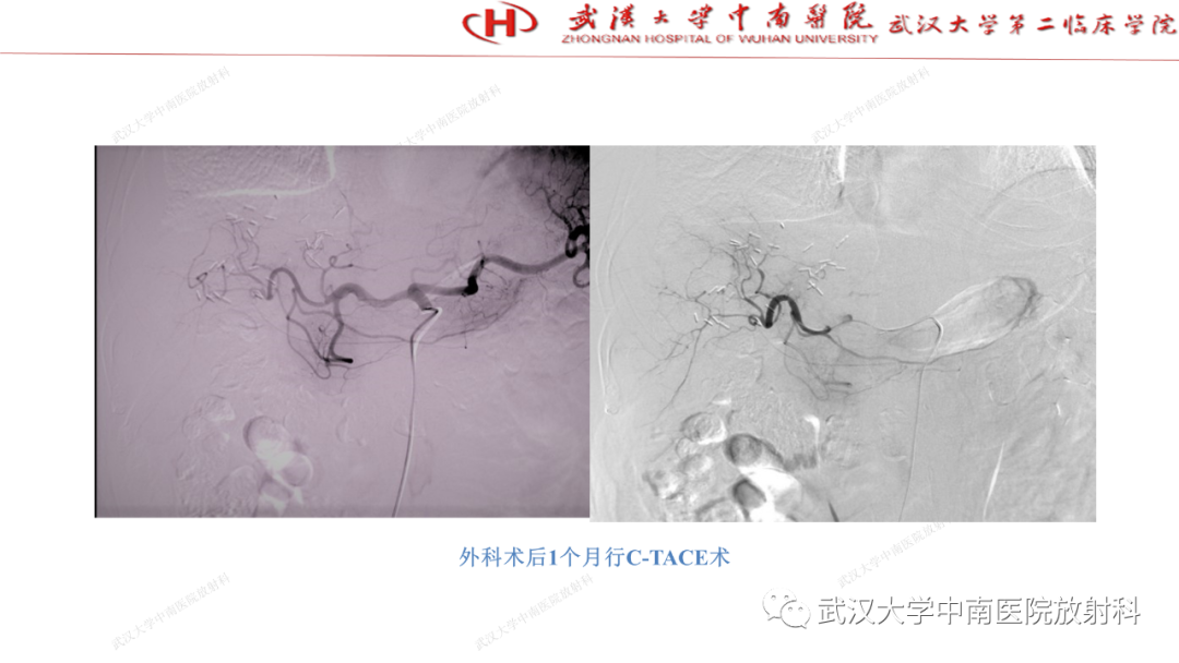 影像PPT - 【PPT】“不可切除”肝癌的TACE转化治疗-40