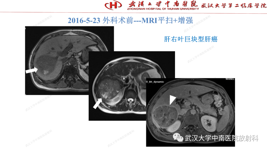 影像PPT - 【PPT】“不可切除”肝癌的TACE转化治疗-46
