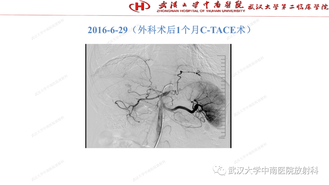影像PPT - 【PPT】“不可切除”肝癌的TACE转化治疗-47