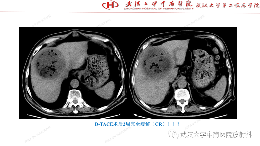 影像PPT - 【PPT】“不可切除”肝癌的TACE转化治疗-37