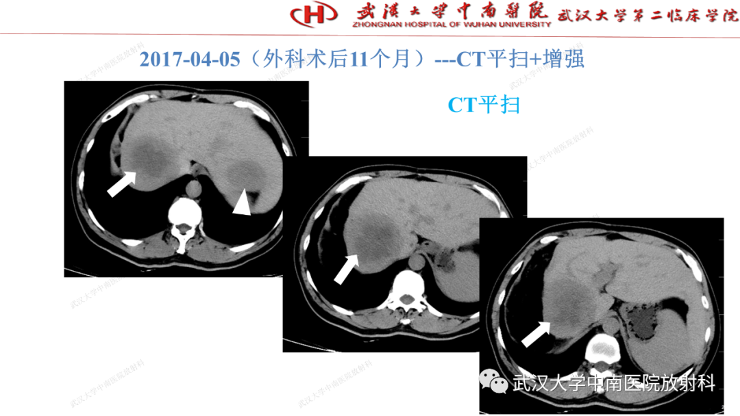 影像PPT - 【PPT】“不可切除”肝癌的TACE转化治疗-48