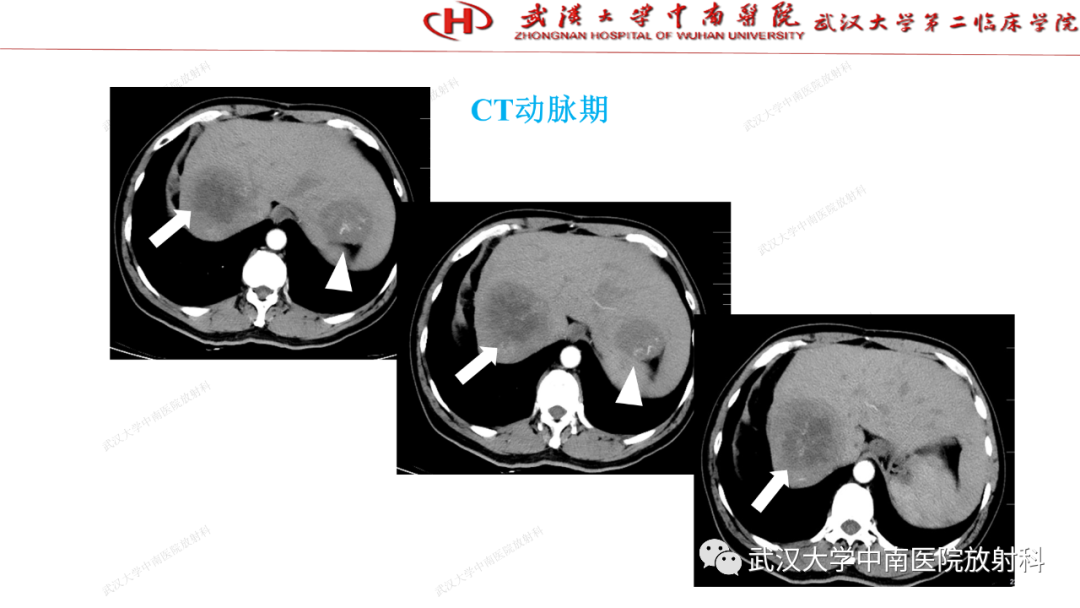 影像PPT - 【PPT】“不可切除”肝癌的TACE转化治疗-49