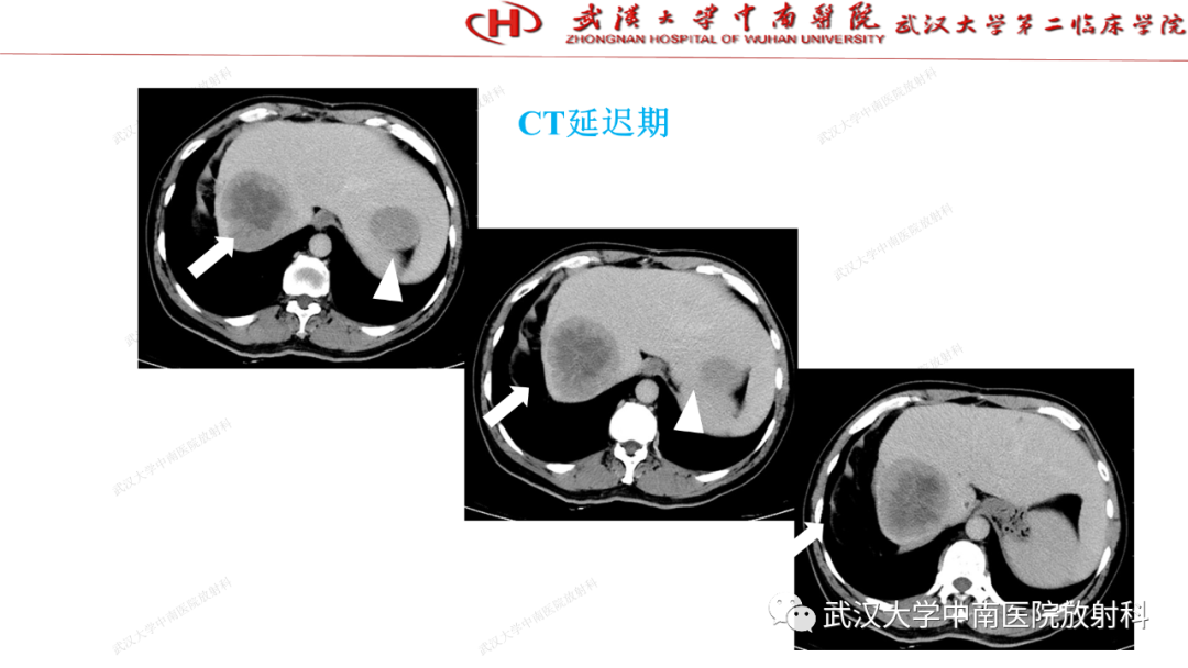 影像PPT - 【PPT】“不可切除”肝癌的TACE转化治疗-50