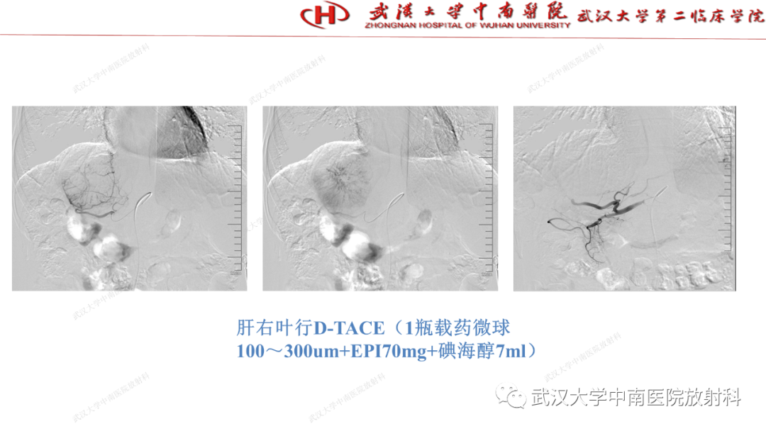 影像PPT - 【PPT】“不可切除”肝癌的TACE转化治疗-56