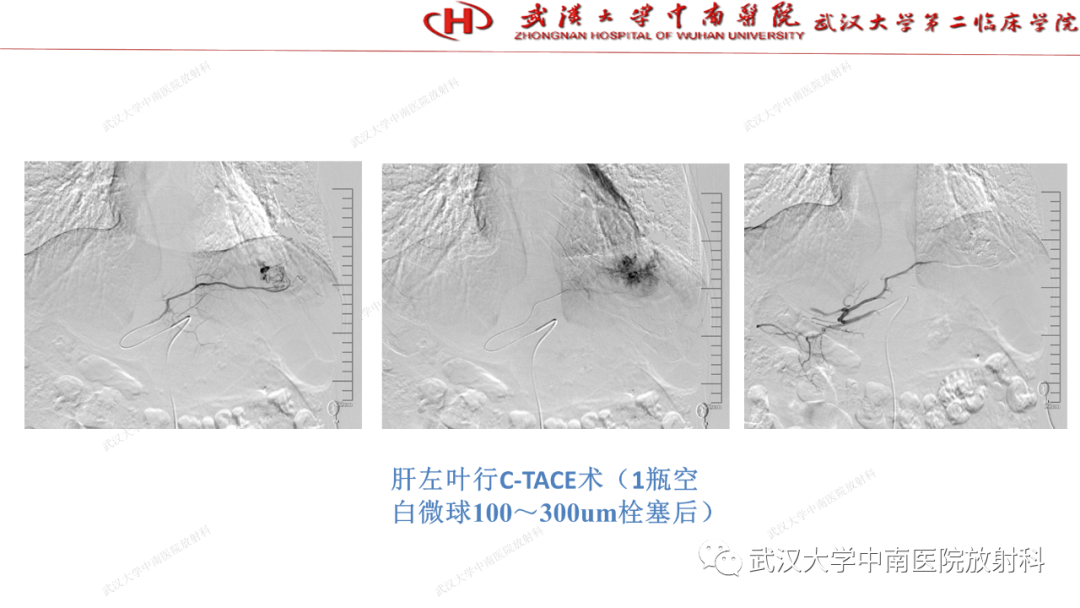 影像PPT - 【PPT】“不可切除”肝癌的TACE转化治疗-57