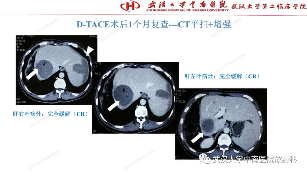 影像PPT - 【PPT】“不可切除”肝癌的TACE转化治疗-58