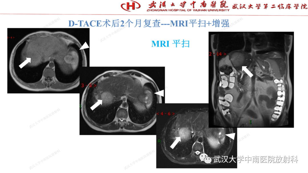 影像PPT - 【PPT】“不可切除”肝癌的TACE转化治疗-59