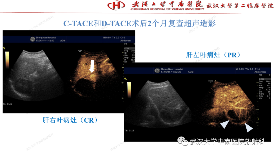 影像PPT - 【PPT】“不可切除”肝癌的TACE转化治疗-61
