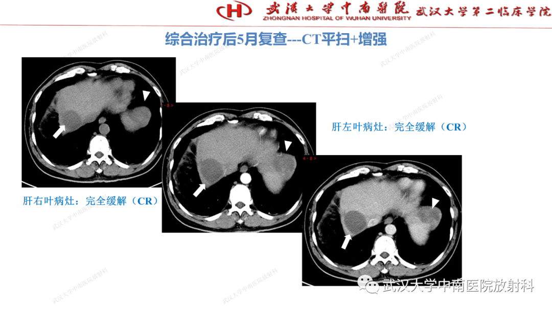 影像PPT - 【PPT】“不可切除”肝癌的TACE转化治疗-62