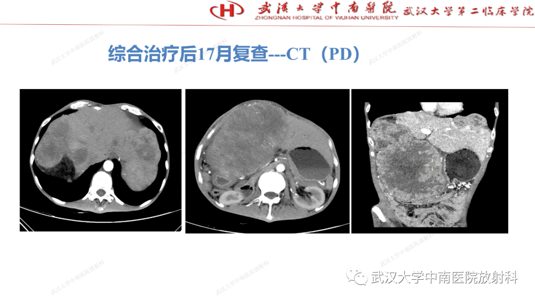 影像PPT - 【PPT】“不可切除”肝癌的TACE转化治疗-63