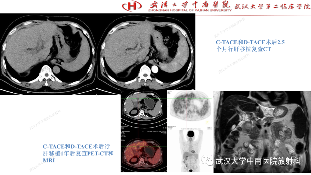 影像PPT - 【PPT】“不可切除”肝癌的TACE转化治疗-75