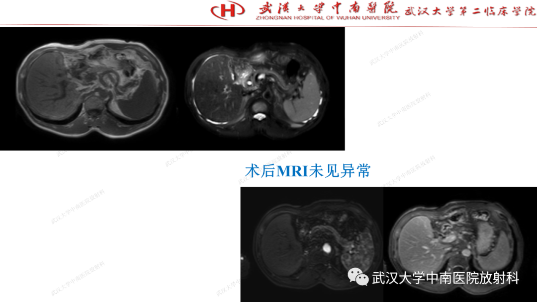影像PPT - 【PPT】“不可切除”肝癌的TACE转化治疗-82