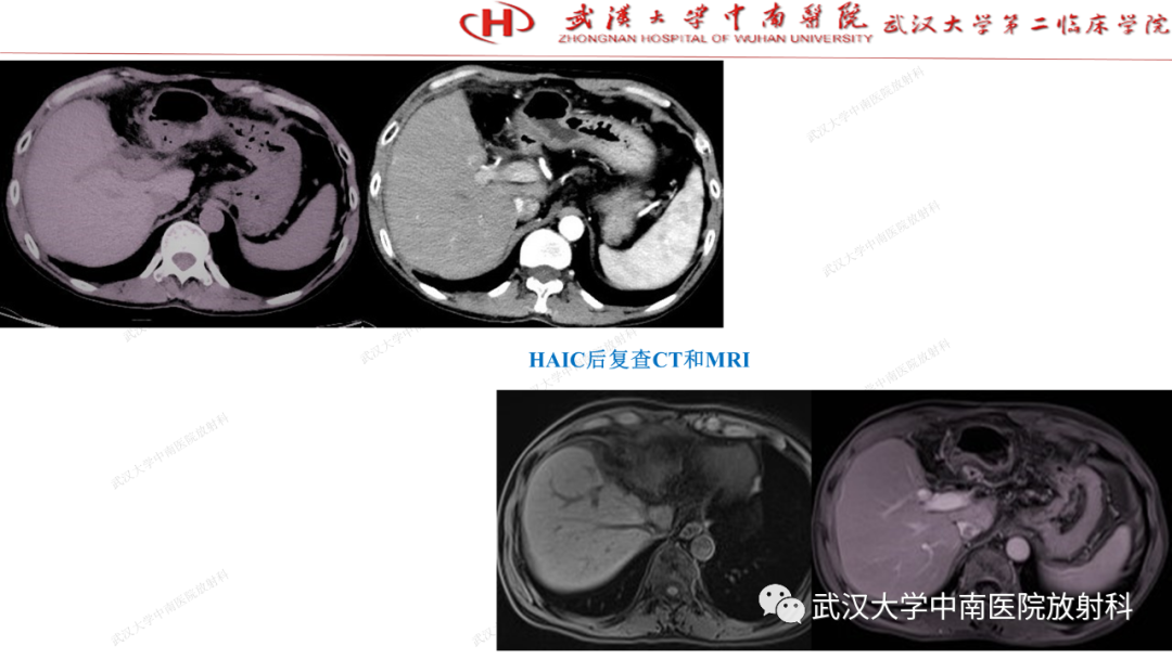 影像PPT - 【PPT】“不可切除”肝癌的TACE转化治疗-84