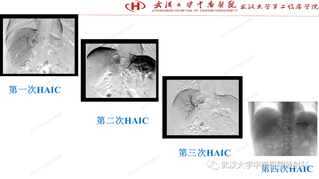 影像PPT - 【PPT】“不可切除”肝癌的TACE转化治疗-83