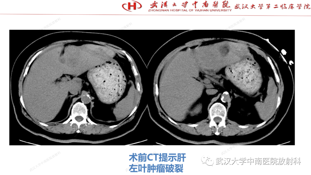 影像PPT - 【PPT】“不可切除”肝癌的TACE转化治疗-95