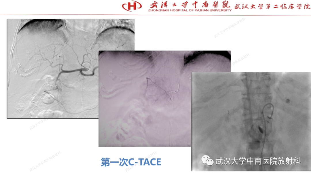 影像PPT - 【PPT】“不可切除”肝癌的TACE转化治疗-96