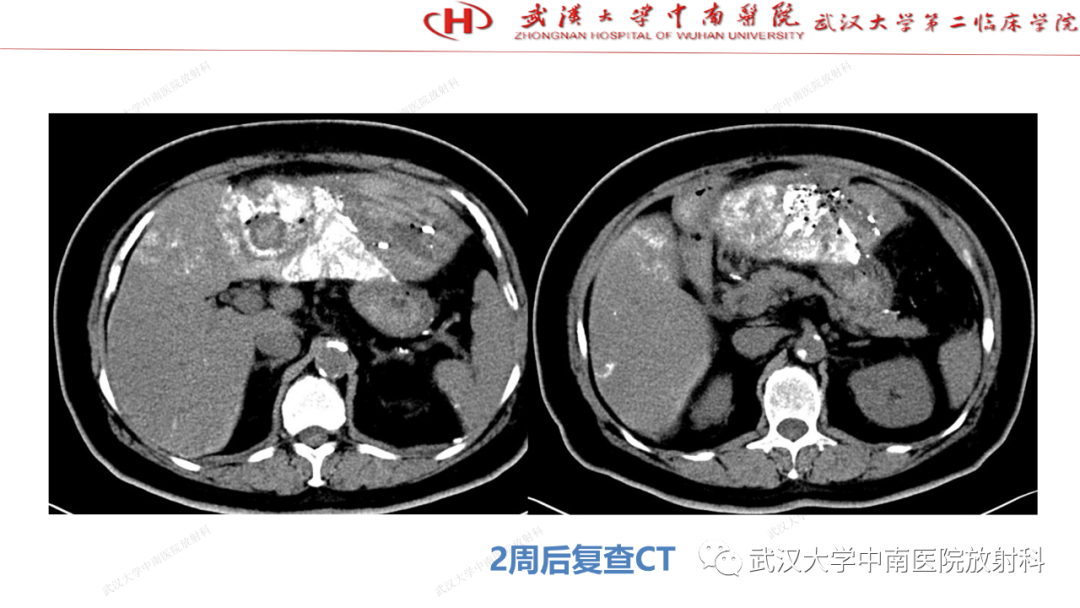 影像PPT - 【PPT】“不可切除”肝癌的TACE转化治疗-97