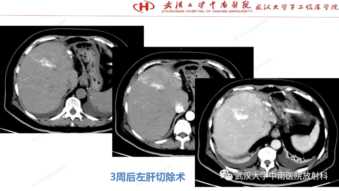 影像PPT - 【PPT】“不可切除”肝癌的TACE转化治疗-98