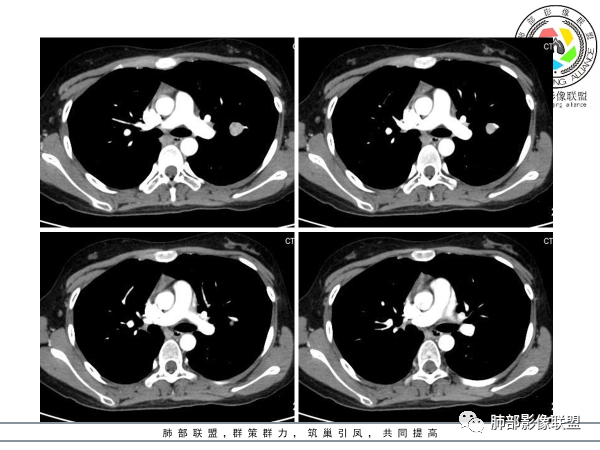 影像PPT - 【病例】肺透明细胞糖瘤1例CT影像-12 影像PPT - 【病例】肺透明细胞糖瘤1例CT影像-12