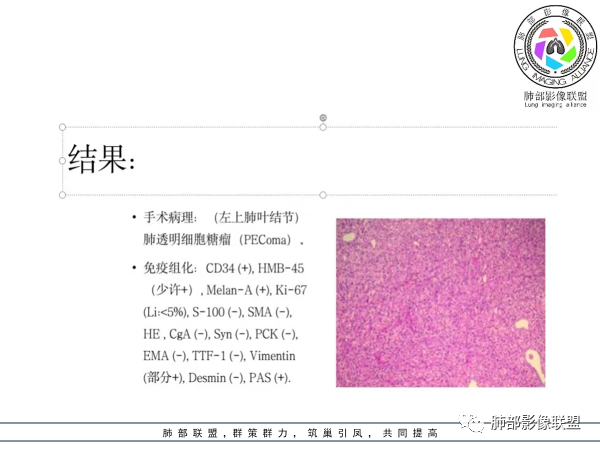 影像PPT - 【病例】肺透明细胞糖瘤1例CT影像-20 影像PPT - 【病例】肺透明细胞糖瘤1例CT影像-20