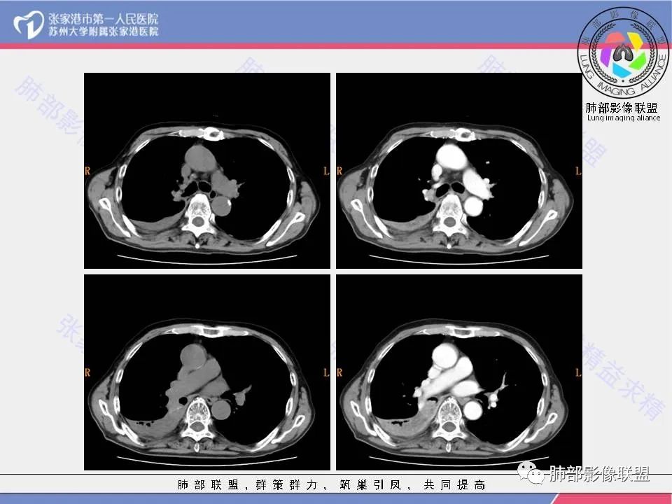 影像PPT - 【病例】肺鳞癌1例CT影像-4