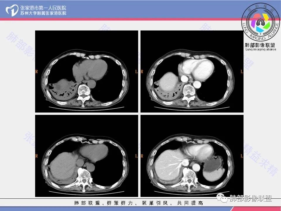 影像PPT - 【病例】肺鳞癌1例CT影像-7