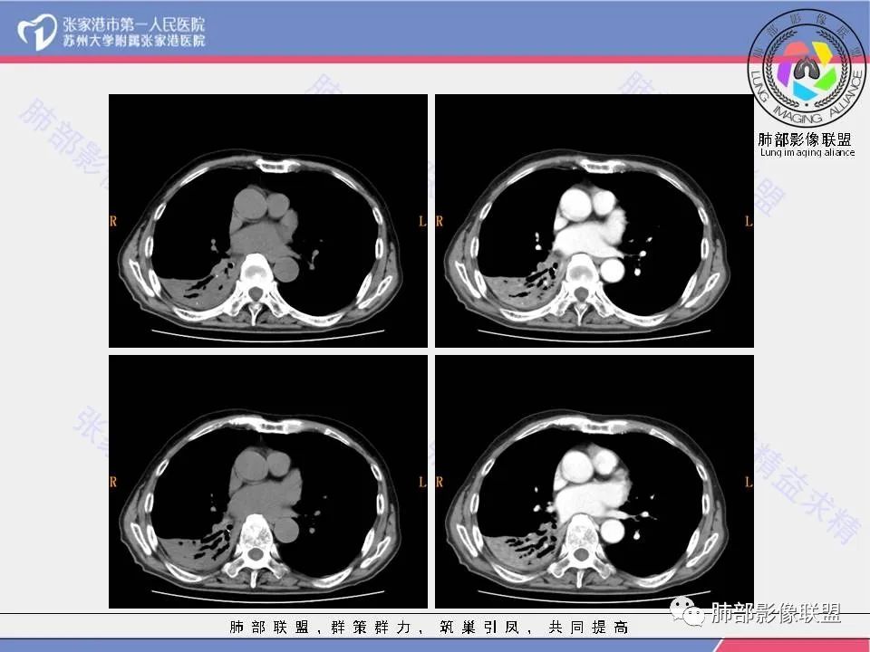 影像PPT - 【病例】肺鳞癌1例CT影像-5