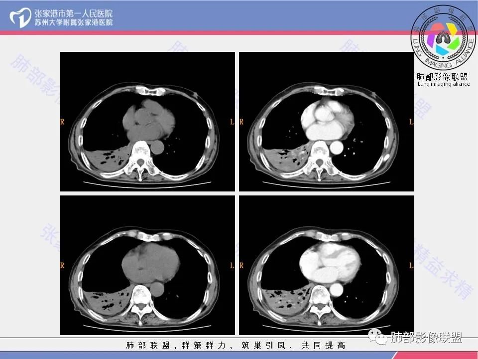 影像PPT - 【病例】肺鳞癌1例CT影像-6