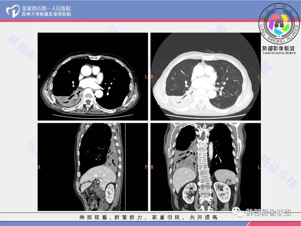 影像PPT - 【病例】肺鳞癌1例CT影像-10