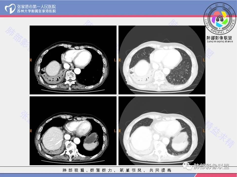 影像PPT - 【病例】肺鳞癌1例CT影像-13