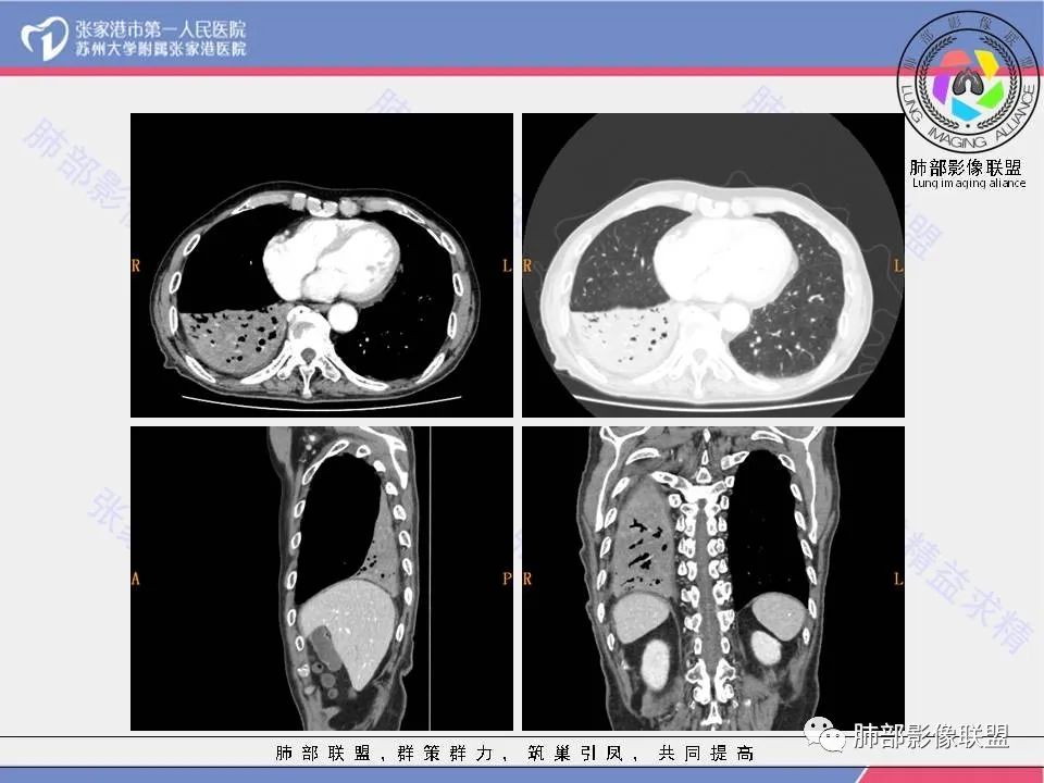 影像PPT - 【病例】肺鳞癌1例CT影像-12