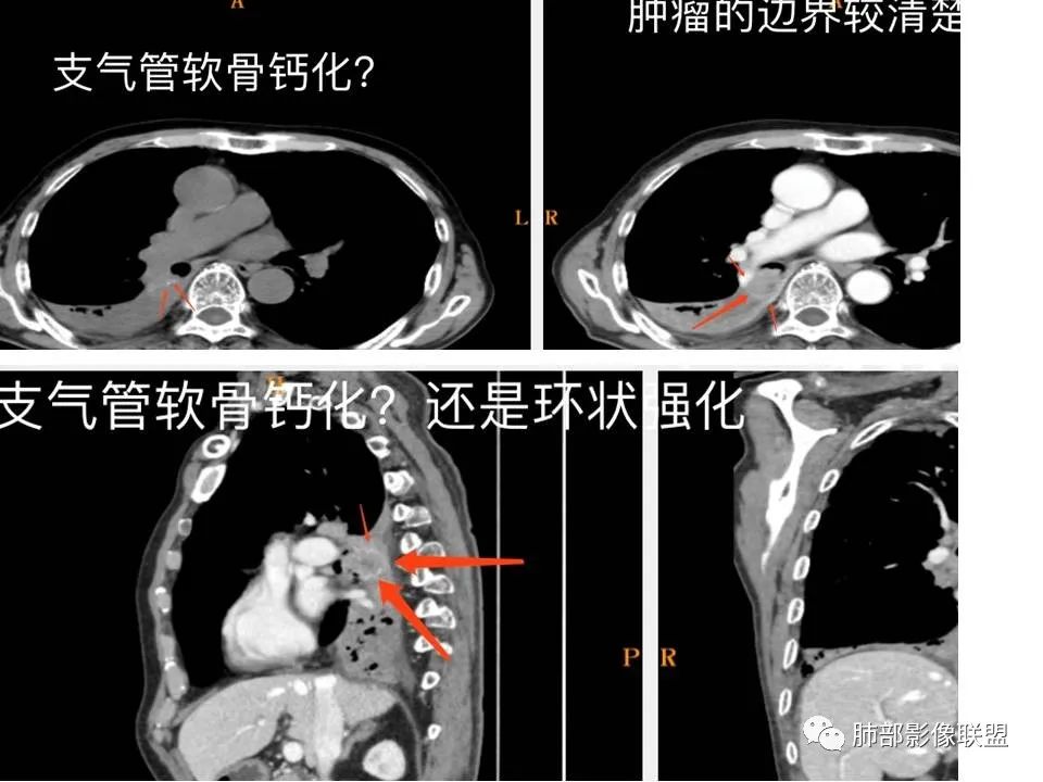 影像PPT - 【病例】肺鳞癌1例CT影像-14