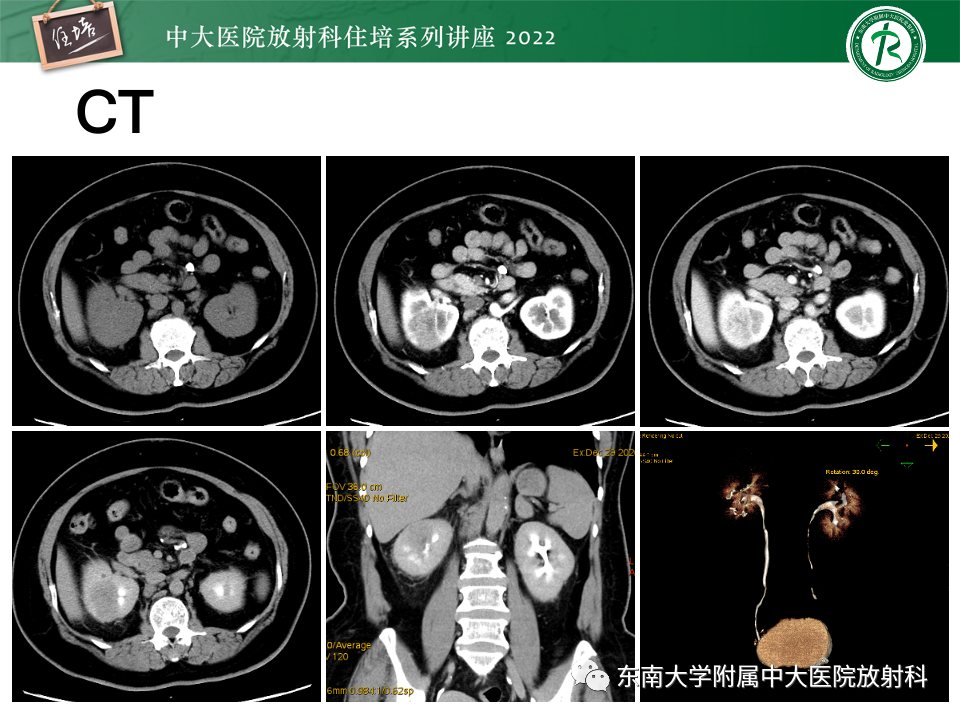 影像PPT - 【PPT】肾盂肾炎的影像表现及鉴别诊断-3