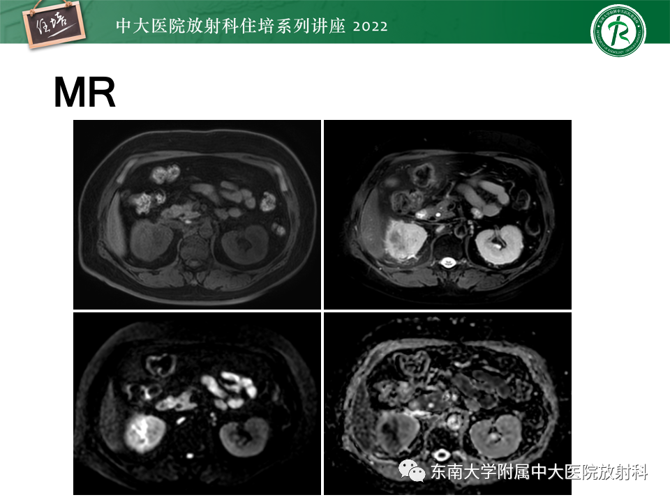 影像PPT - 【PPT】肾盂肾炎的影像表现及鉴别诊断-4