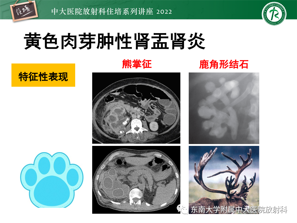 影像PPT - 【PPT】肾盂肾炎的影像表现及鉴别诊断-18