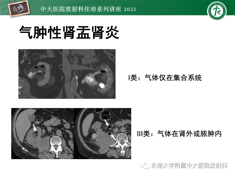 影像PPT - 【PPT】肾盂肾炎的影像表现及鉴别诊断-21