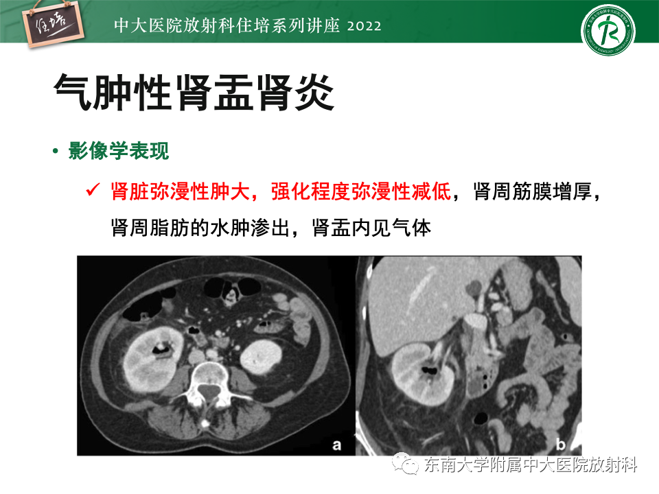 影像PPT - 【PPT】肾盂肾炎的影像表现及鉴别诊断-20