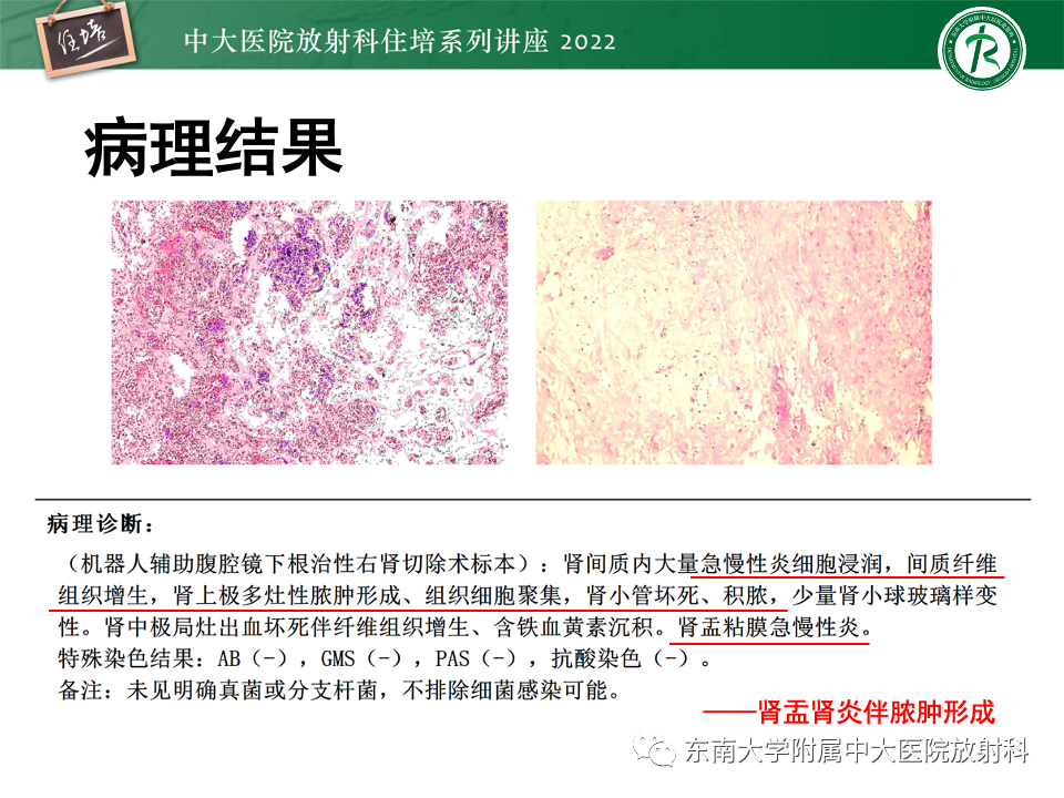 影像PPT - 【PPT】肾盂肾炎的影像表现及鉴别诊断-6